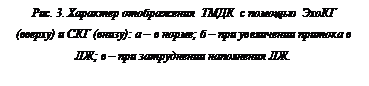 Подпись: Рис. 3. Характер отображения  ТМДК  с помощью  ЭхоКГ  (вверху) и СКГ (внизу): а – в норме; б – при увеличении притока в ЛЖ; в – при затруднении на¬полнения ЛЖ.