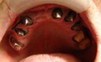 Подготовка полости рта к лечению заболеваний твердых тканей зубов