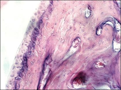 Липоевая кислота при ревматоидном артрите