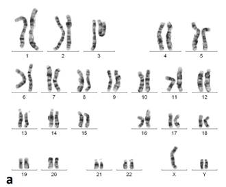 Синдром дисомии у хромосом картинки