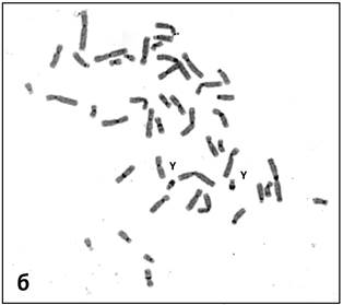 Синдром дисомии у хромосом картинки