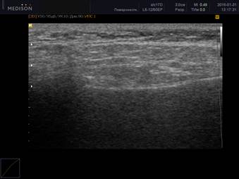 Поражение слюнных желез при ревматоидном артрите thumbnail